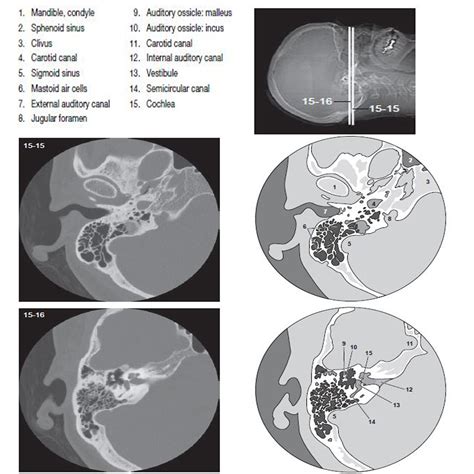 bones temp 9|abnormal ct scan temporal bone.